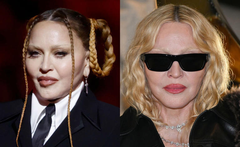 Antes e depois de Madonna chama atenção: quais procedimentos ela fez?