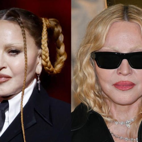 Antes e depois de Madonna chama atenção: quais procedimentos ela fez?