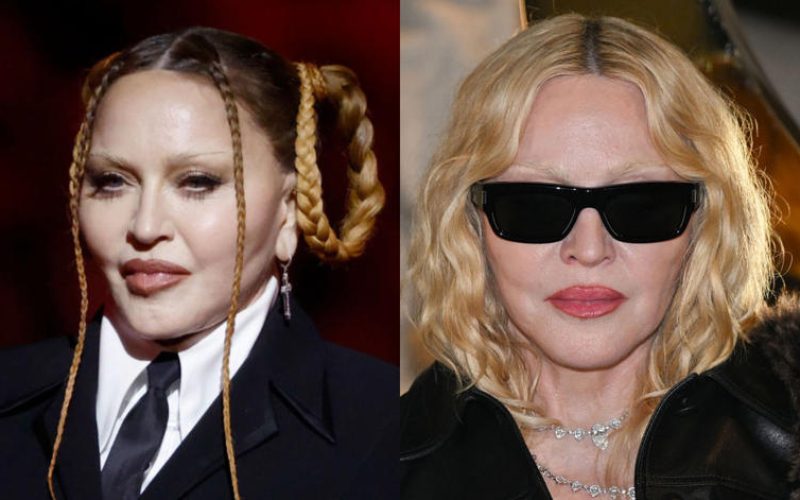 Antes e depois de Madonna chama atenção: quais procedimentos ela fez?