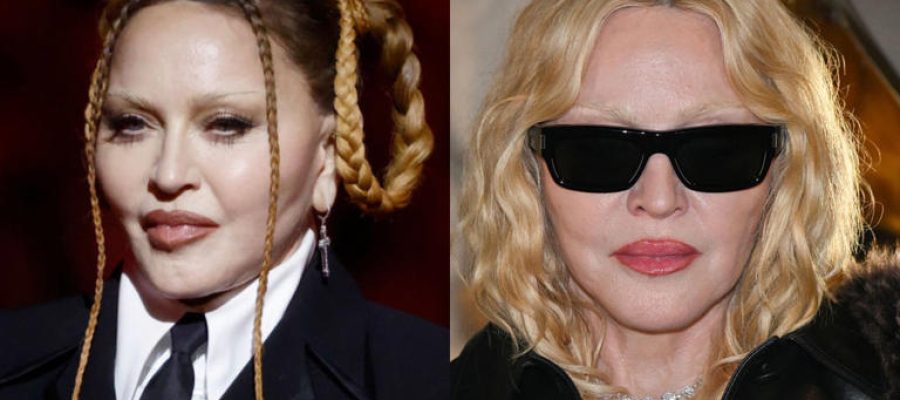 Antes e depois de Madonna chama atenção: quais procedimentos ela fez?
